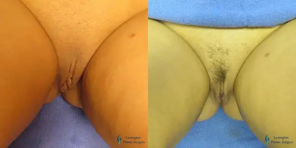 Ear Surgery Patient 1