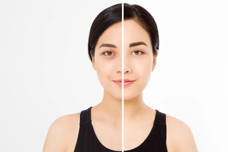 Facelift Recovery Timeline Facelift Recovery Timeline