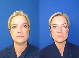 Kybella