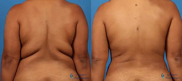 Liposuction