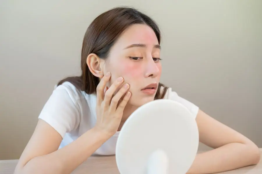 Vampire facelift_ The disadvantages - Redness Vampire facelift_ The disadvantages - Redness