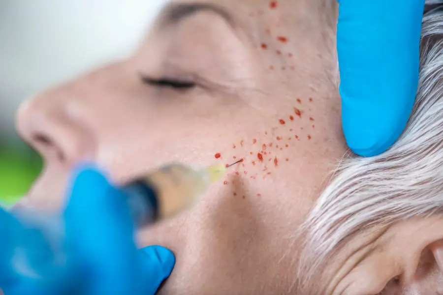 What are PRP injections What are PRP injections