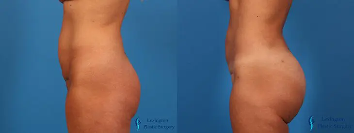Butt Lift