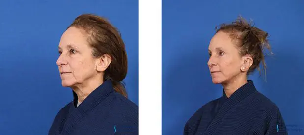 Eyelid Surgery