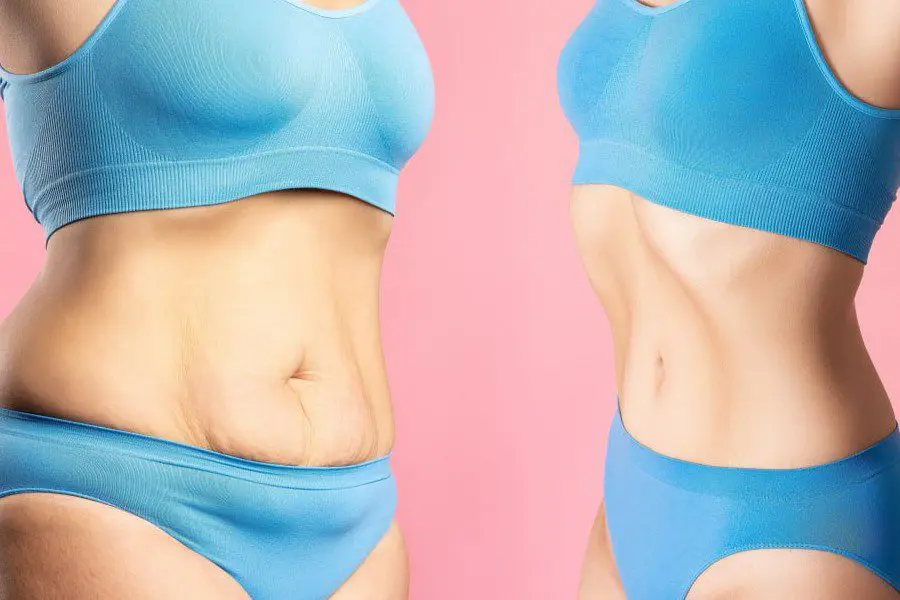Common Helpful Practices after tummy tuck Common Helpful Practices after tummy tuck