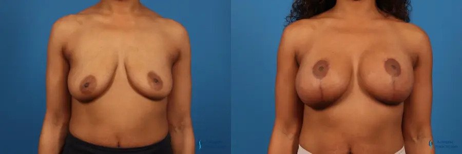Breast Augmentation With Lift: Patient 4