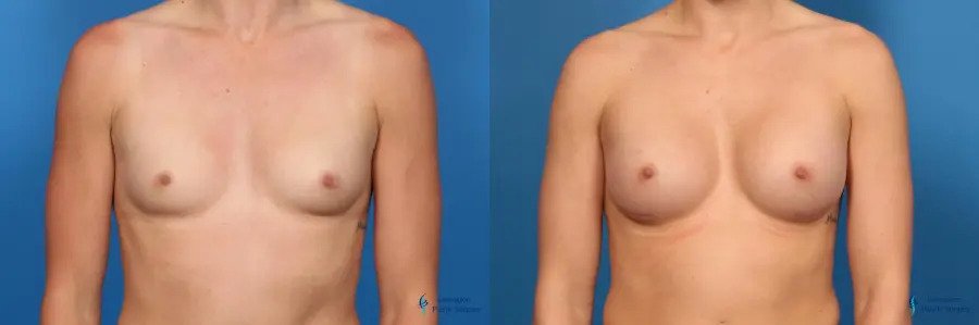Breast Augmentation: Patient 10