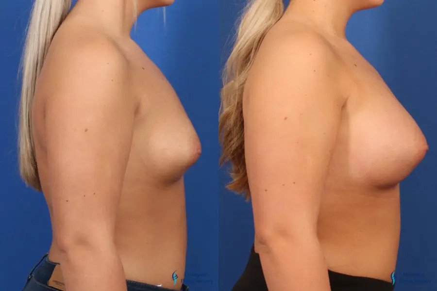 Breast Augmentation: Patient 6