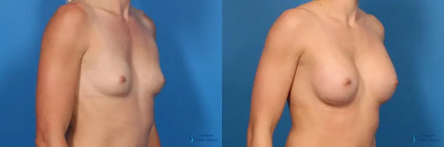 Breast Augmentation: Patient 10