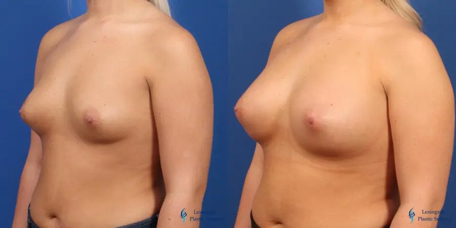 Breast Augmentation: Patient 6