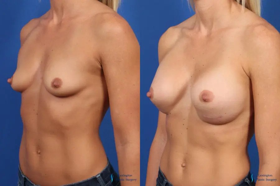 Breast Augmentation: Patient 7