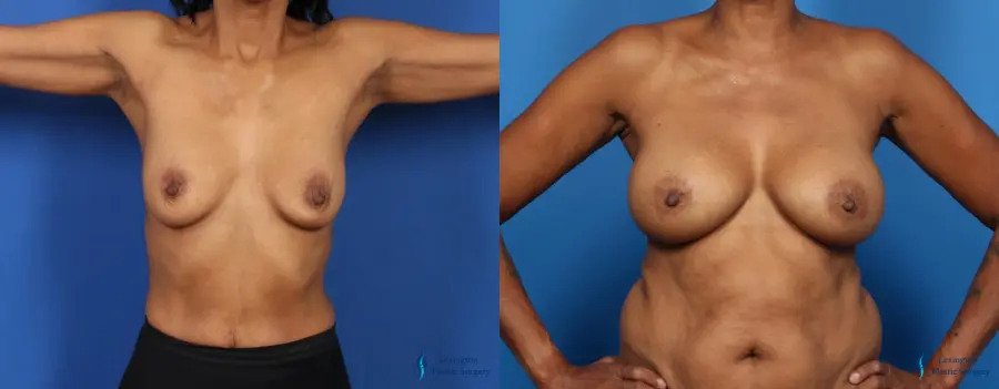 Breast Augmentation: Patient 8