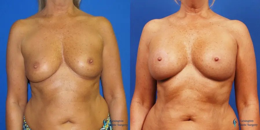 Breast Augmentation With Lift: Patient 1