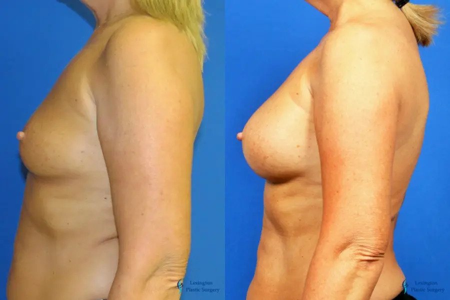 Breast Augmentation With Lift: Patient 1