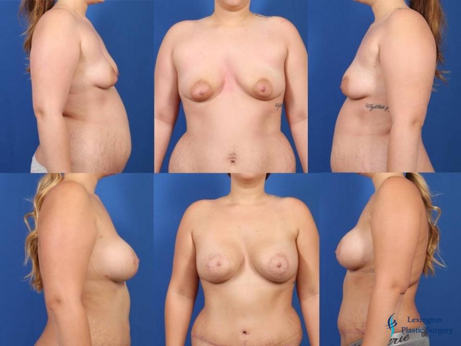 Breast Augmentation With Lift: Patient 2