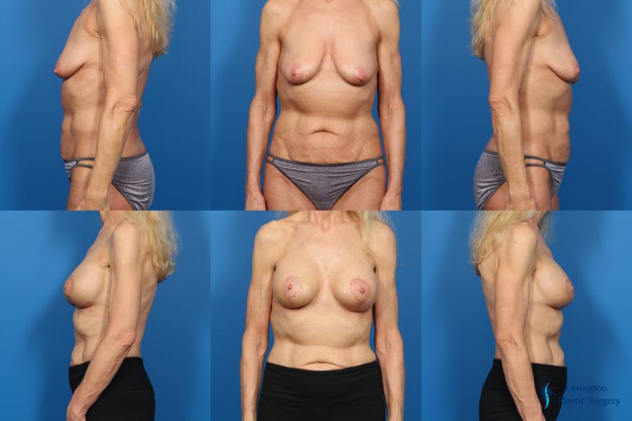 Breast Augmentation With Lift: Patient 3