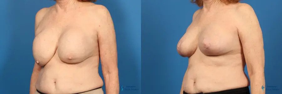 Breast Implant Removal With Lift: Patient 2
