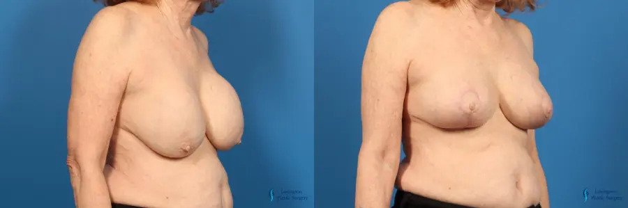 Breast Implant Removal With Lift: Patient 2