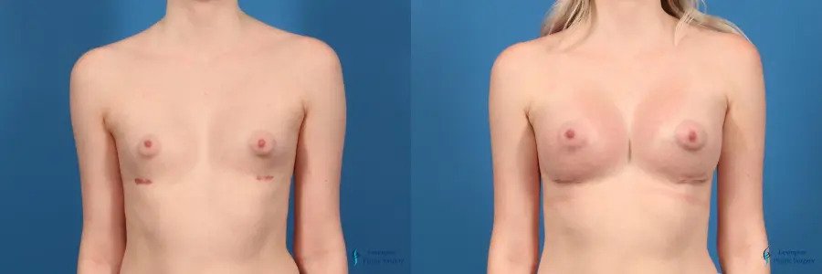 Breast Reconstruction: Patient 1