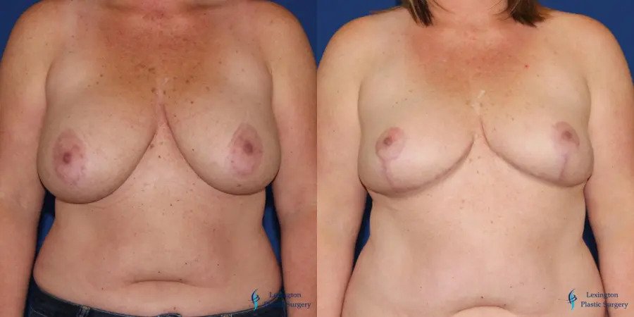 Breast Reduction: Patient 3