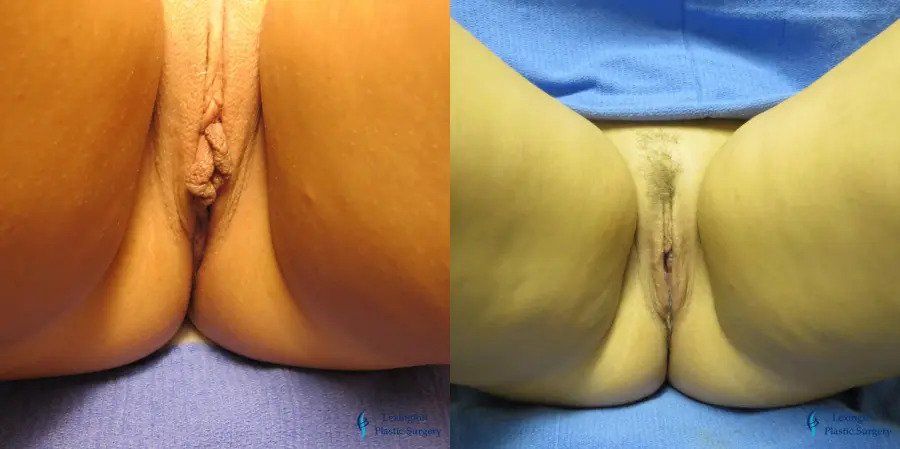 Labiaplasty: Patient 1