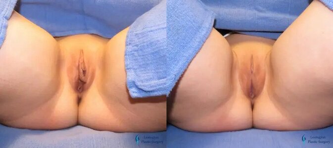 Labiaplasty: Patient 10