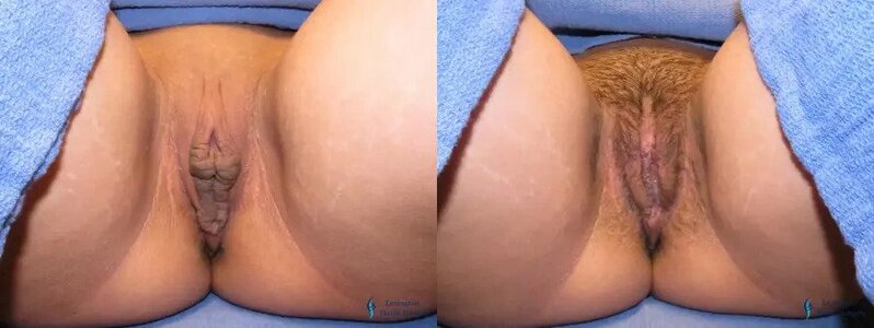 Labiaplasty: Patient 13