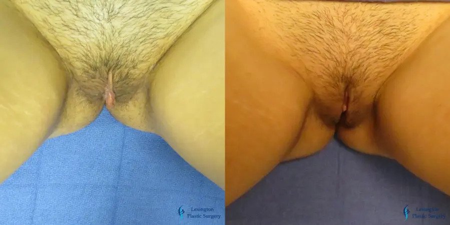 Labiaplasty: Patient 5
