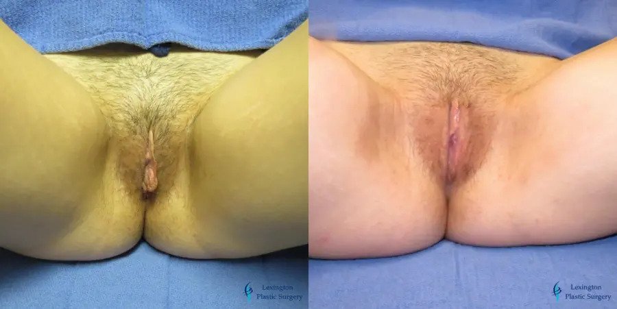 Labiaplasty: Patient 5