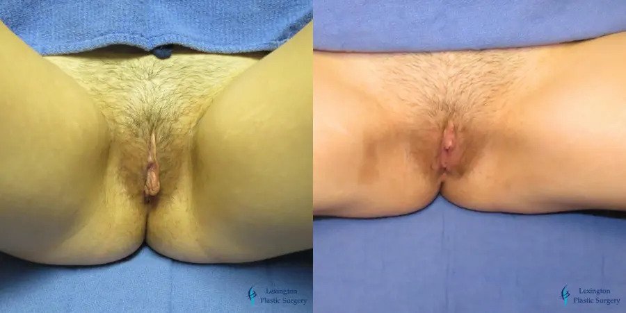 Labiaplasty: Patient 6