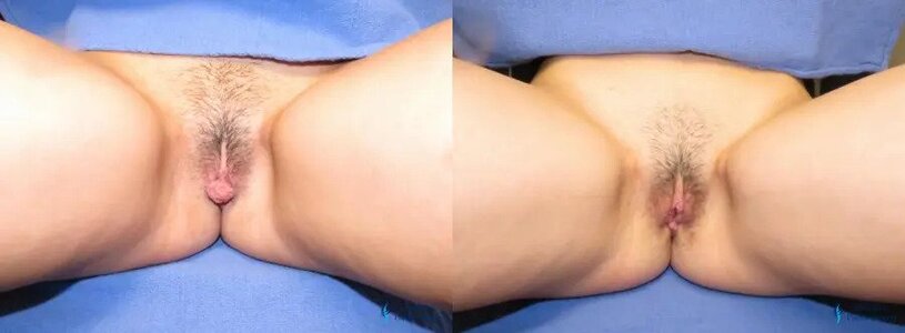 Labiaplasty: Patient 7