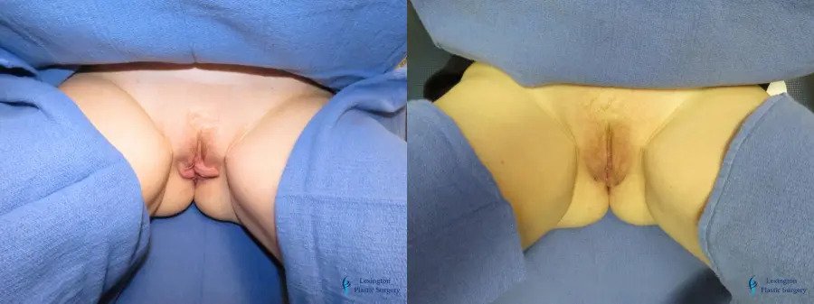 Labiaplasty: Patient 8