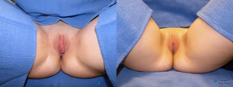 Labiaplasty: Patient 9