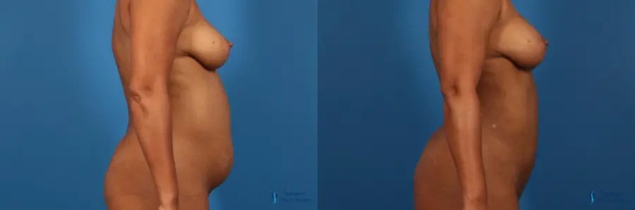 Liposuction: Patient 3