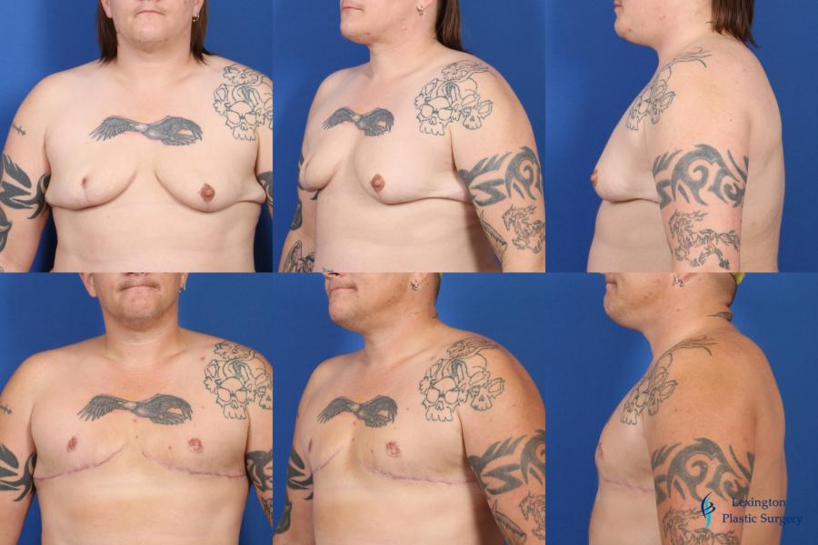 Top Surgery - Female To Male: Patient 3