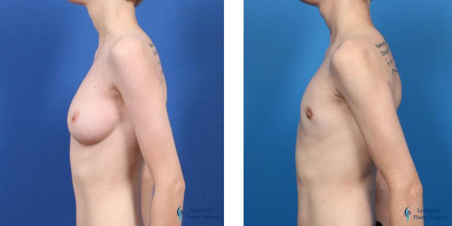 Top Surgery - Female To Male: Patient 4