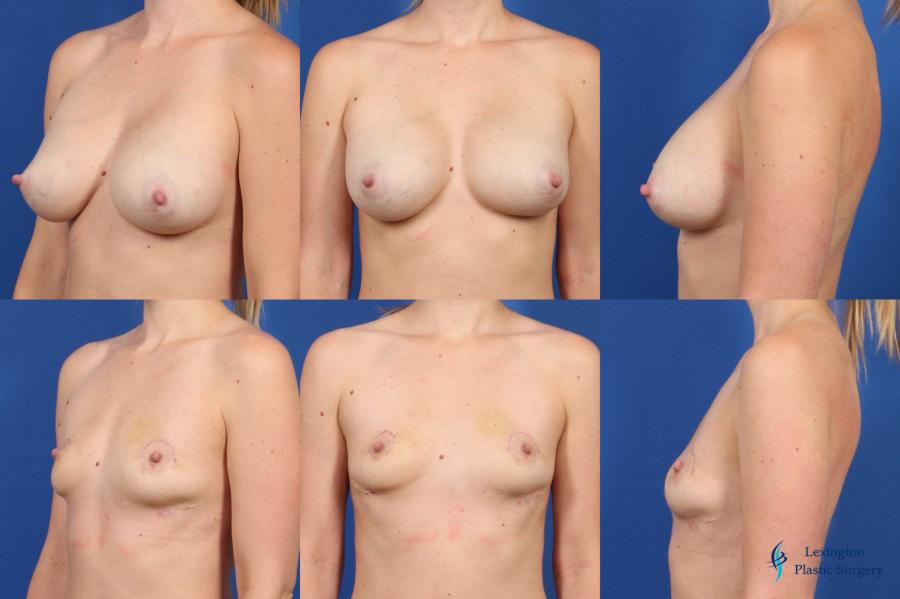 Breast Implant Removal With Lift: Patient 1