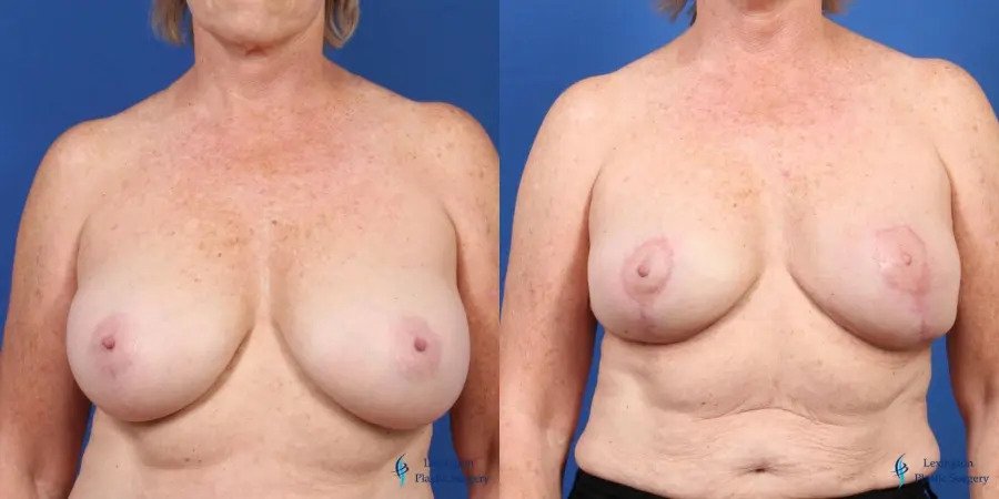 Breast Lift: Patient 1