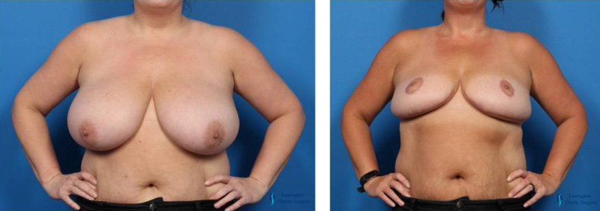 Breast Reduction: Patient 4