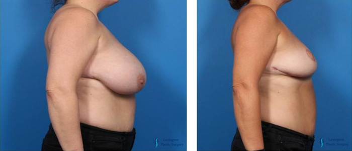 Breast Reduction: Patient 4