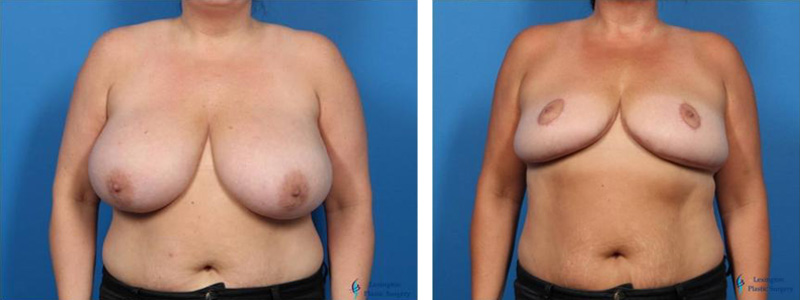 Breast Lift: Patient 2