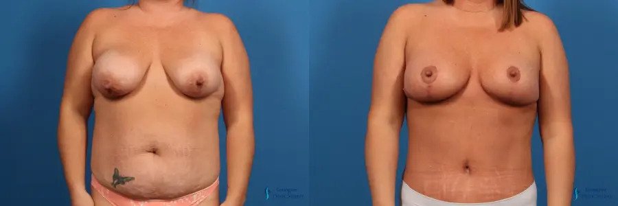Breast Lift: Patient 3