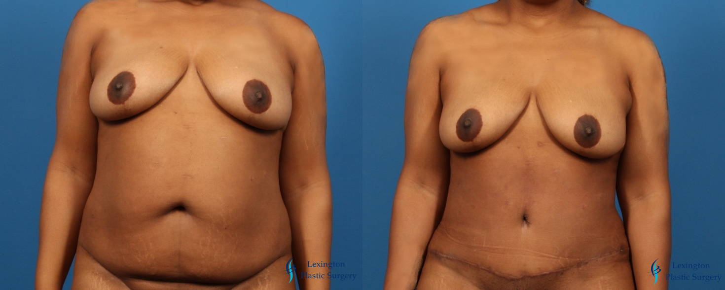 Abdominoplasty: Patient 13