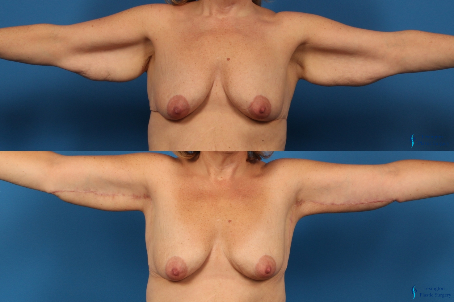 Breast Implant Exchange: Patient 1