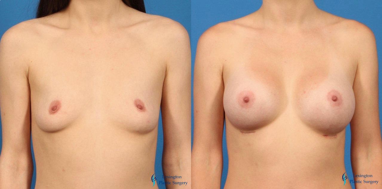 Breast Augmentation: Patient 12