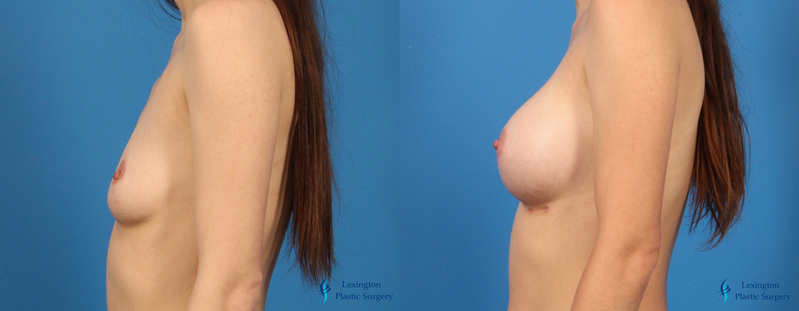 Breast Implant Exchange: Patient 1