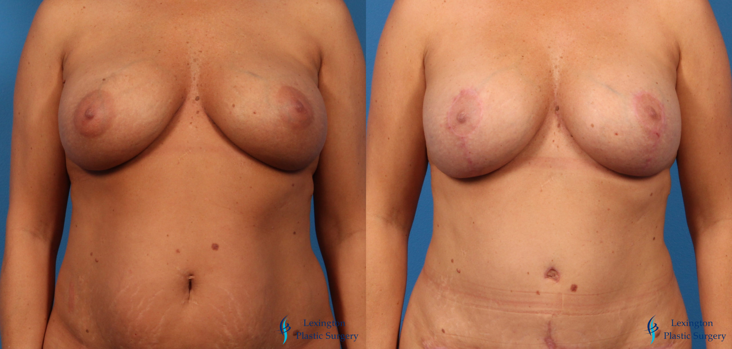 Breast Augmentation With Lift: Patient 4