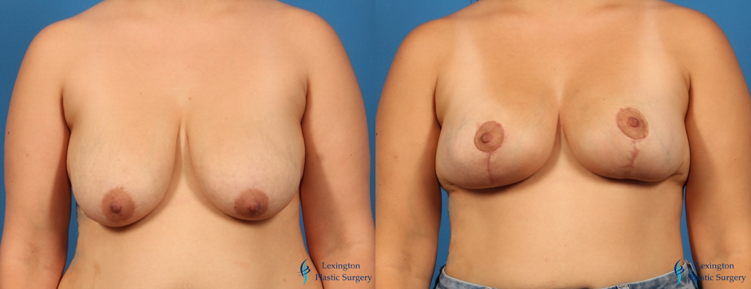 Breast Lift: Patient 1