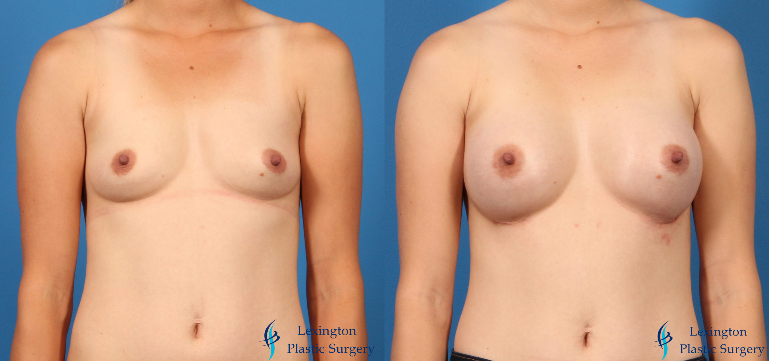 Breast Augmentation: Patient 14