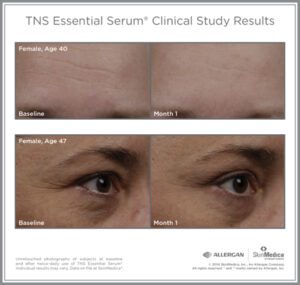a tns advanced+ serum before and after photo of a 40 year old woman